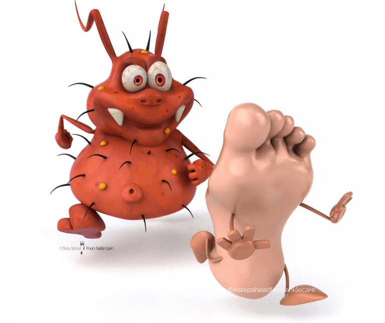 Fungal infection and its Homeopathic Treatment kidney failure treatment