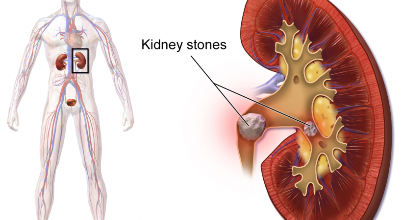 KidneyStones