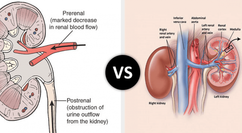 kidney-failure-treatment-in-delhi